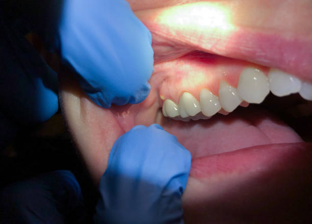 Best Emergency Gum Treatment in New Lenox, IL